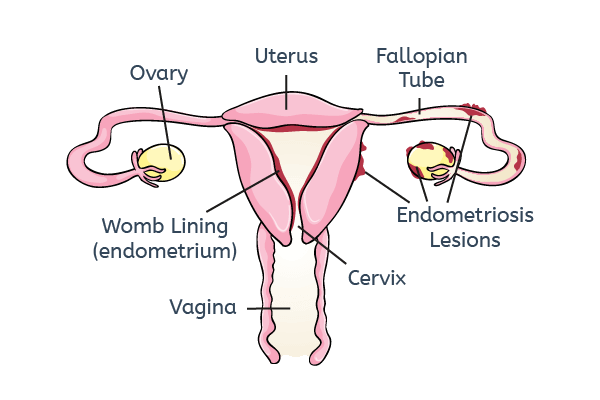 Infertility in Women